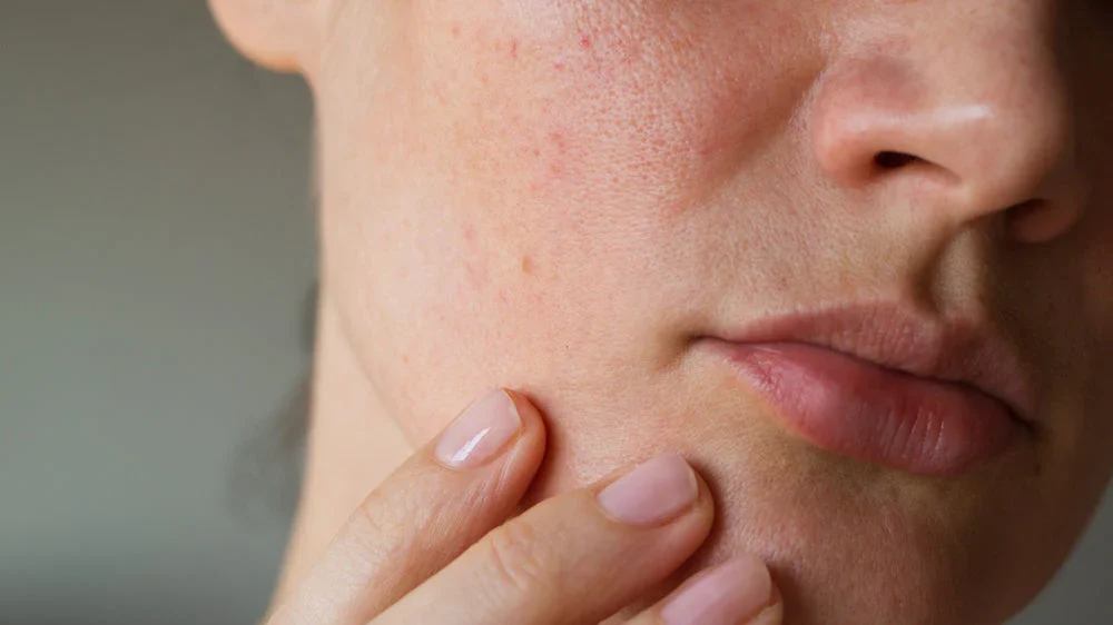 Best Natural Soap : oily skin